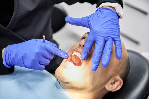 Best Emergency Wisdom Teeth Removal in Picayune, MS